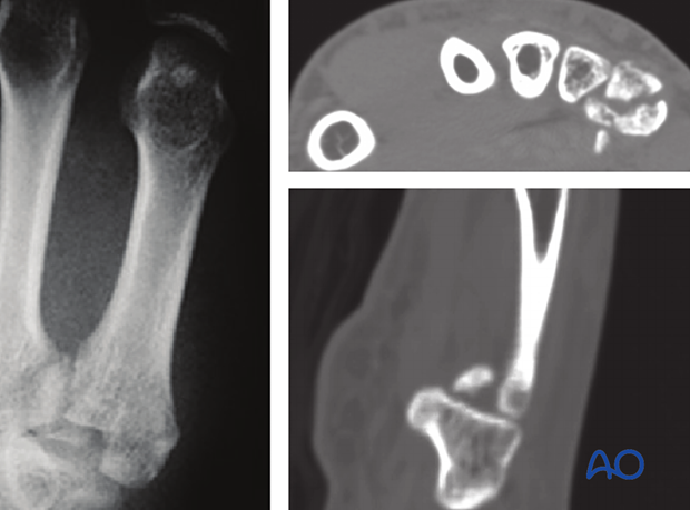 AP x-ray and two CT views of an articular fracture of the 5th metacarpal base