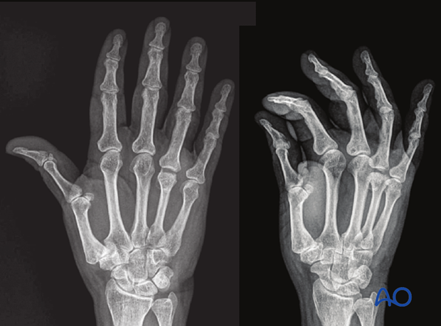 AP and oblique x-rays of the hand showing a palmar coronal fracture of the 4th metacarpal head