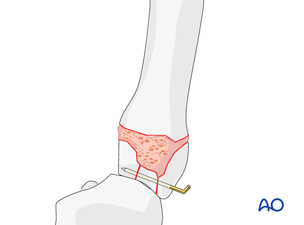 Use of bone graft in metacarpals