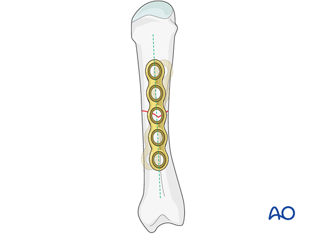 Application of a plate to the metacarpal shaft