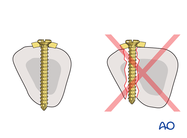 Screw insertion during plate application to a metacarpal bone