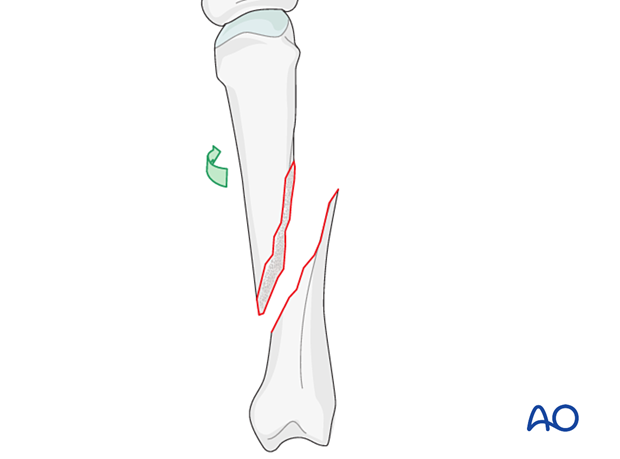 Rotation of finger for direct visualization of an oblique metacarpal fracture