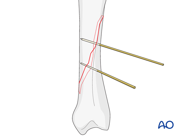 Two K-wires inserted to provisionally hold reduction of an oblique metacarpal fracture