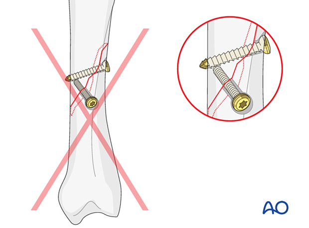 In lag-screw fixation of an oblique metacarpal fracture, the screws should not converge to one point on the far cortex.