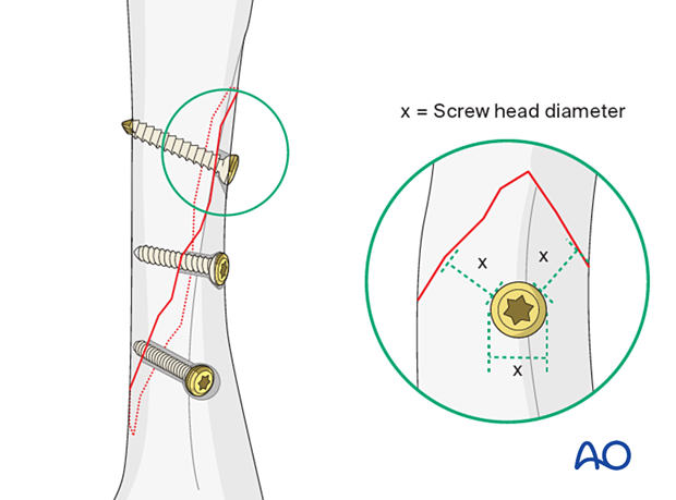 Screw placement not close to the fracture apex and with minimal distance to the fracture line equal to the diameter of the screw head