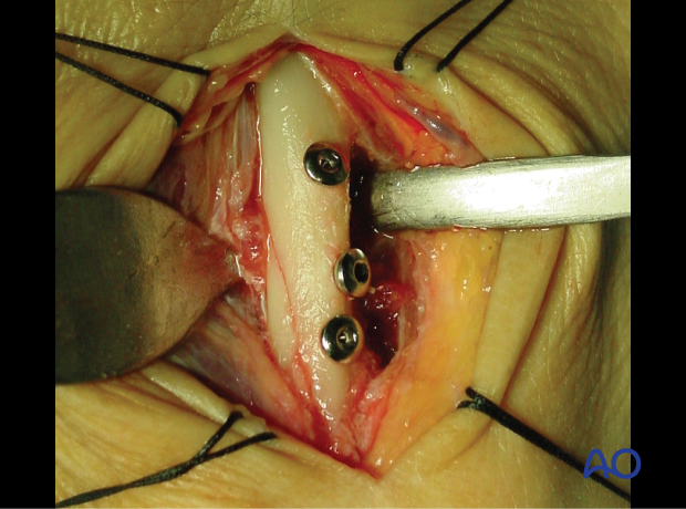 intraoperative photo showing the lag screw fixation of a spiral fracture of the 3rd metacarpal shaft