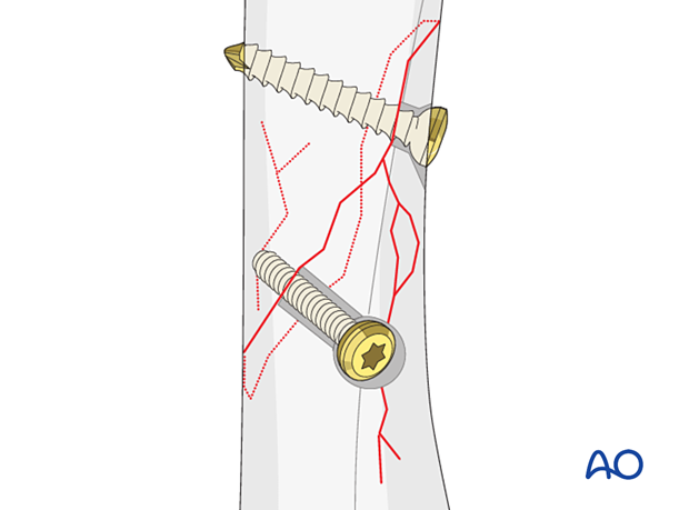 Screws inserted to avoid passing through short fissures