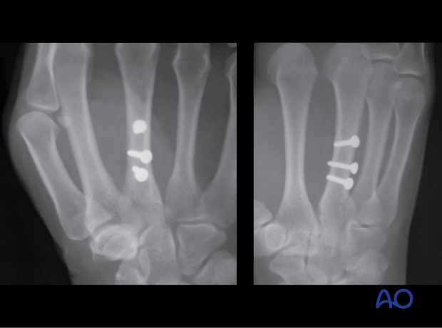 AP and oblique x-ray showing lag screw fixation of a spiral fracture of the 3rd metacarpal shaft