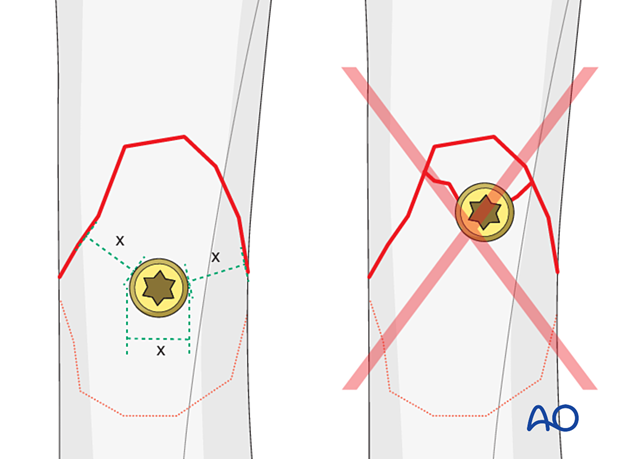 Lag screw fixation with neutralization plate of an oblique metacarpal fracture – screw distance to the fracture line