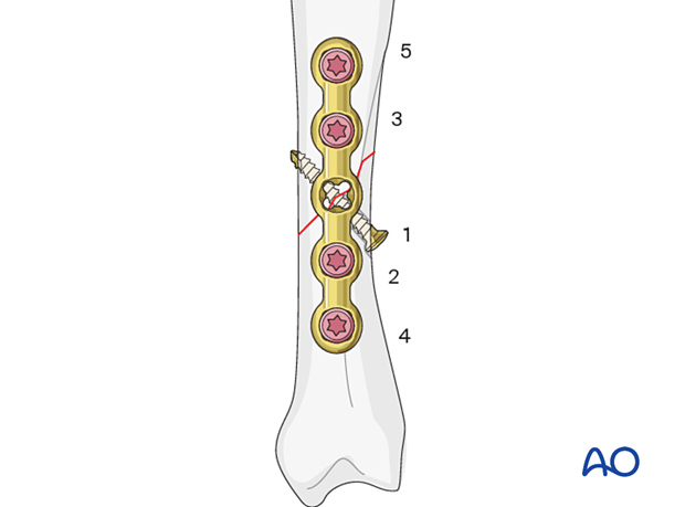 Lag screw fixation with neutralization plate of an oblique metacarpal fracture – order of screw placement