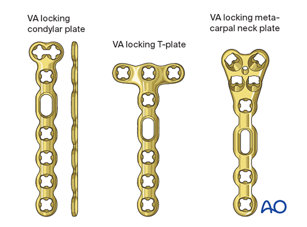 Bridge plating of a multifragmentary extraarticular fracture of the distal metacarpal - Plate selection