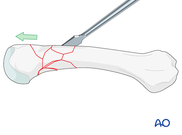 Reduction of a multifragmentary extraarticular fracture of the distal metacarpal