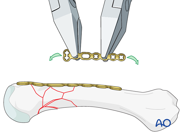 Bridge plating of a multifragmentary extraarticular fracture of the distal metacarpal – plate contouring