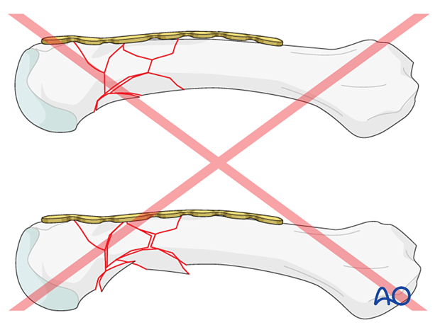 Bridge plating of a multifragmentary extraarticular fracture of the distal metacarpal – pitfall with overbending the plate