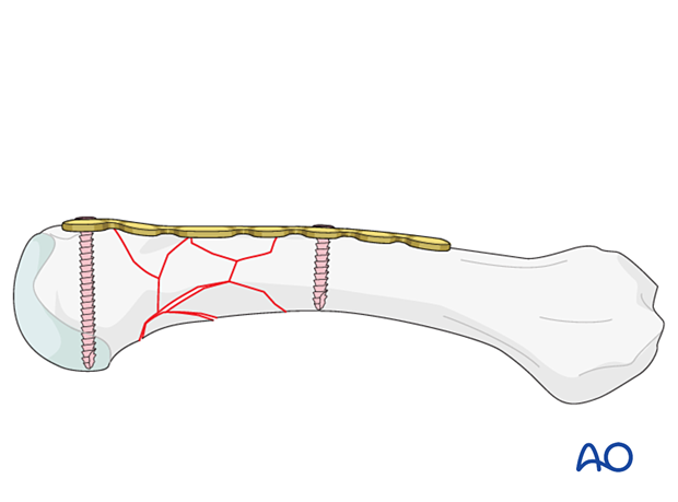 Bridge plating of a multifragmentary extraarticular fracture of the distal metacarpal – screw insertion in both main fragments