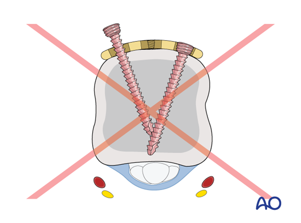 Compression with a T-plate of a transverse extraarticular fracture of the metacarpal head – interfering screws