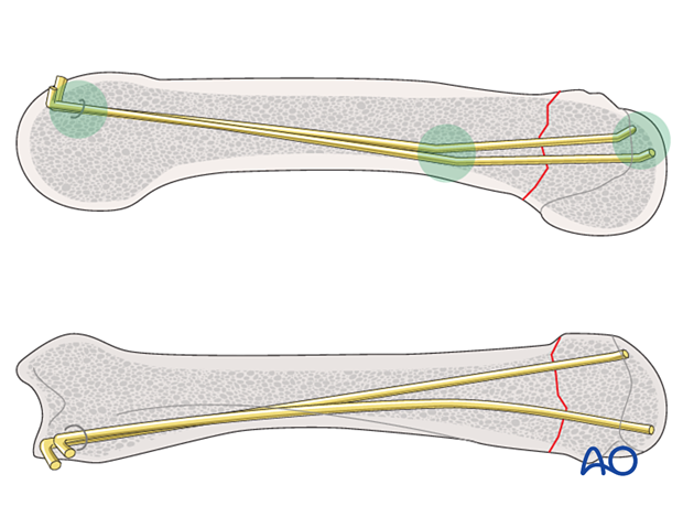 Intramedullary K-wire fixation of an extraarticular fracture of the metacarpal head