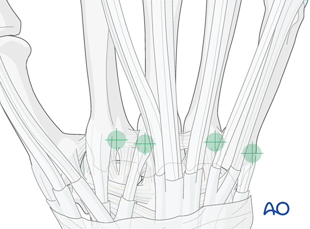 Location of entry points for intramedullary K-wire fixation of extraarticular metacarpal head fractures