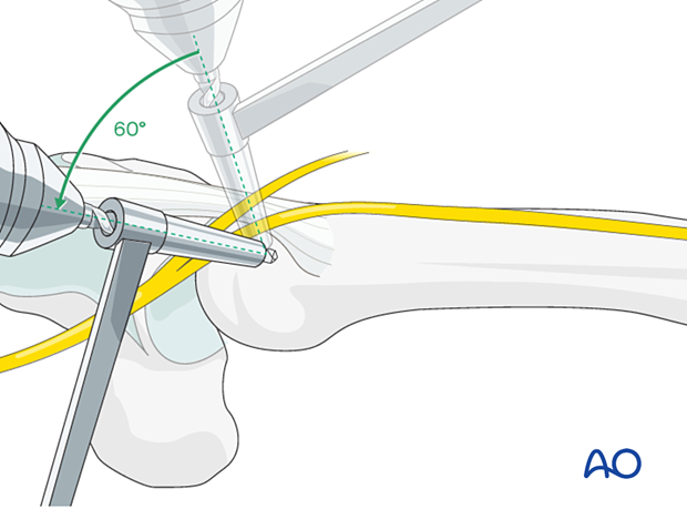 Intramedullary K-wire fixation of extraarticular metacarpal head fractures – Preparing the entry portal