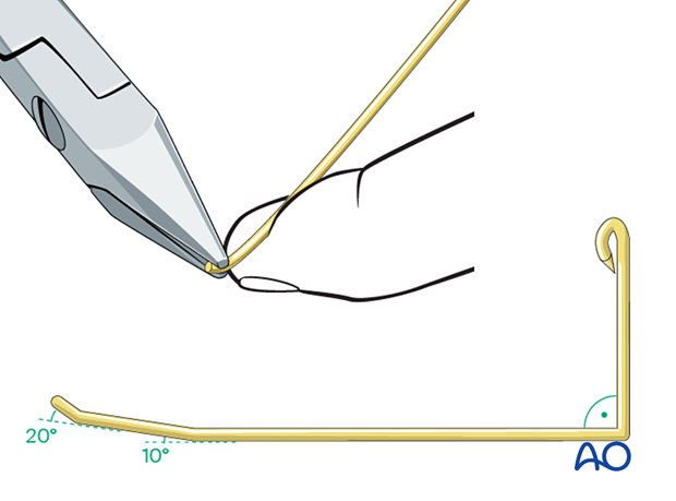 Intramedullary K-wire fixation of extraarticular metacarpal head fractures – Prebending the K-wires