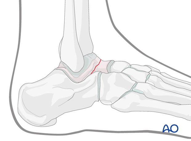 anterolateral approach to the talus