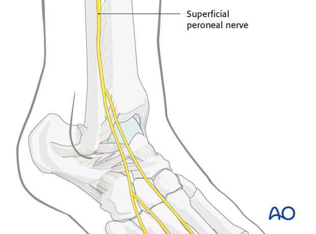 anterolateral approach to the talus