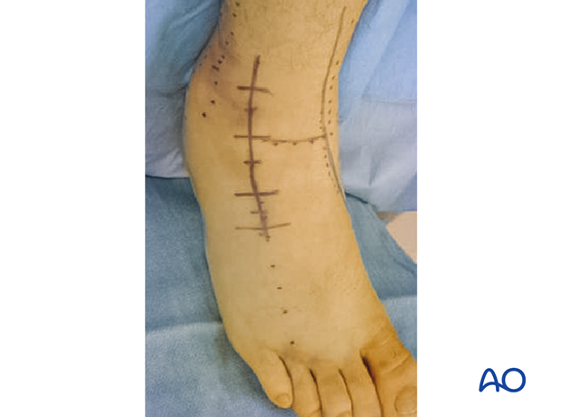 anterolateral approach to the talus