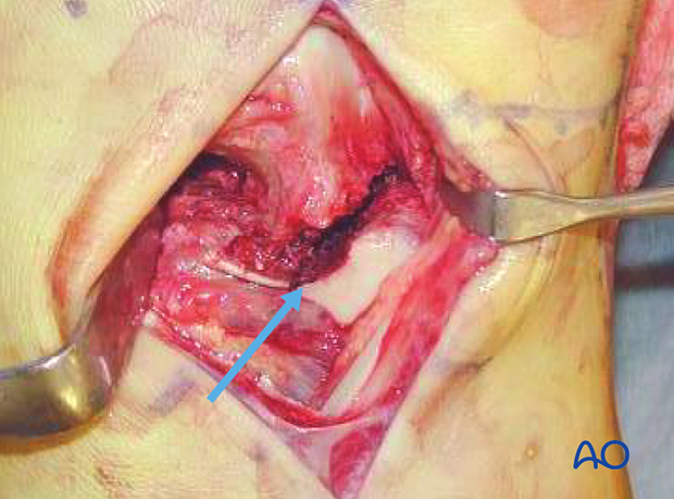 anterolateral approach to the talus