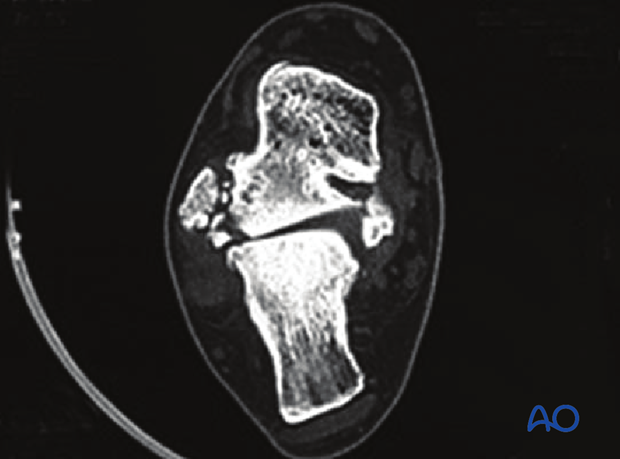 direct lateral approach to the talus