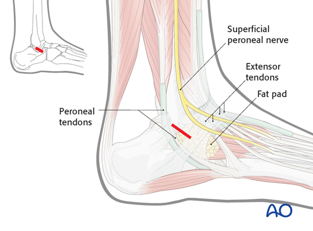 direct lateral approach to the talus