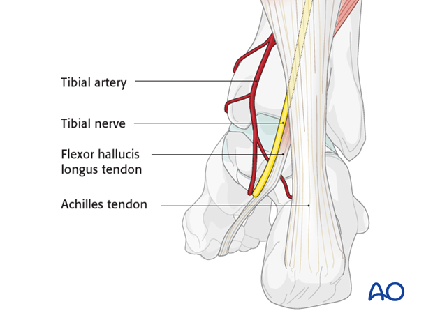 posteromedial approach to the talus