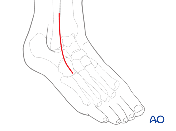 lateral malleolar osteotomy