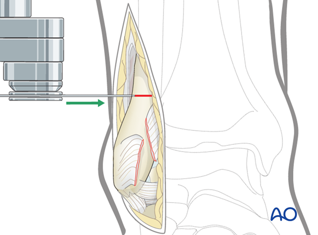 lateral malleolar osteotomy