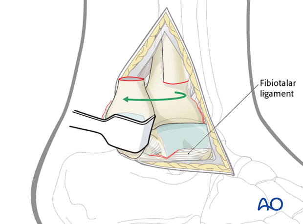 Lateral malleolar osteotomy