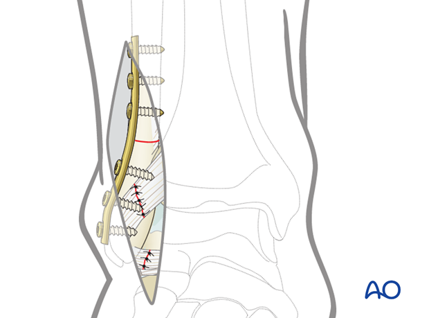 lateral malleolar osteotomy