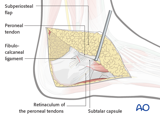 extended lateral approach to the calcaneus