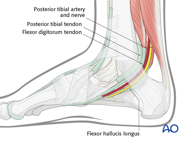 medial approach to the calcaneus