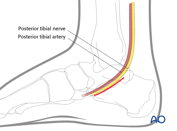 medial approach to the calcaneus