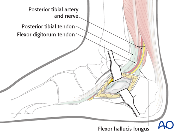 medial approach to the calcaneus