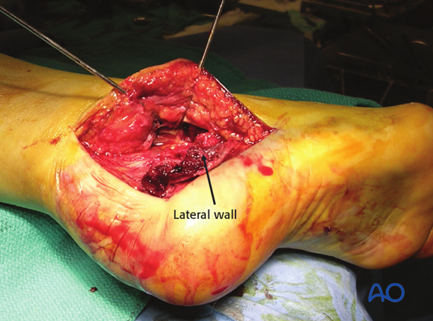 extended lateral approach to the calcaneus