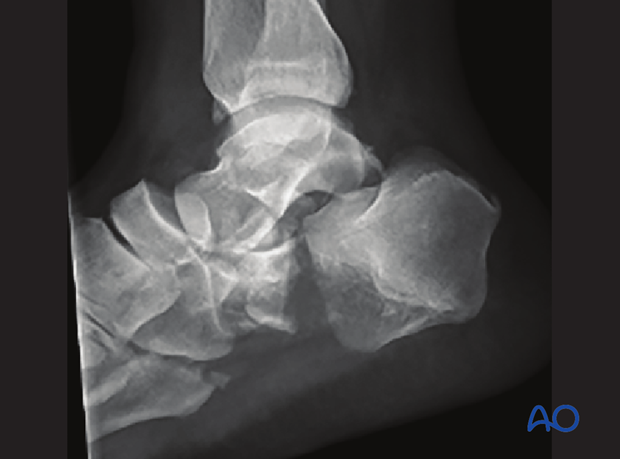 combined hindfoot injuries