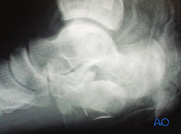 combined hindfoot injuries