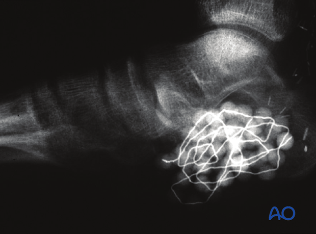 combined hindfoot injuries