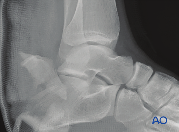 mio posterior approach to the calcaneus