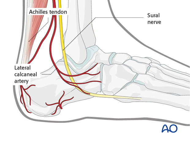 mio posterior approach to the calcaneus