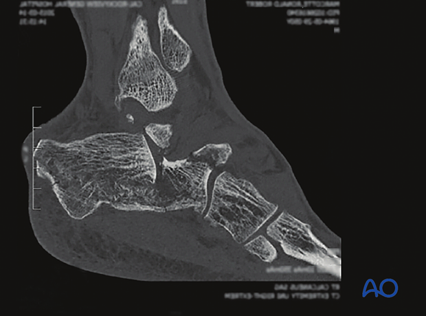 sinus tarsi approach to the calcaneus