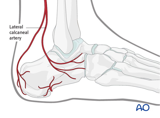 sinus tarsi approach to the calcaneus