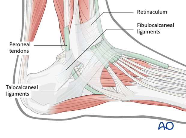 sinus tarsi approach to the calcaneus