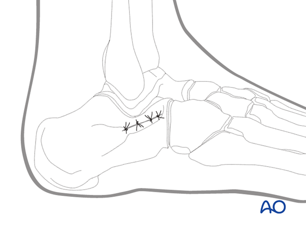 sinus tarsi approach to the calcaneus