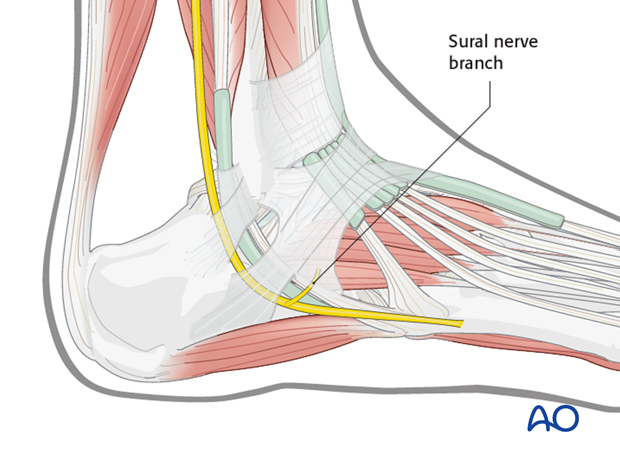 mio lateral approach to the calcaneus